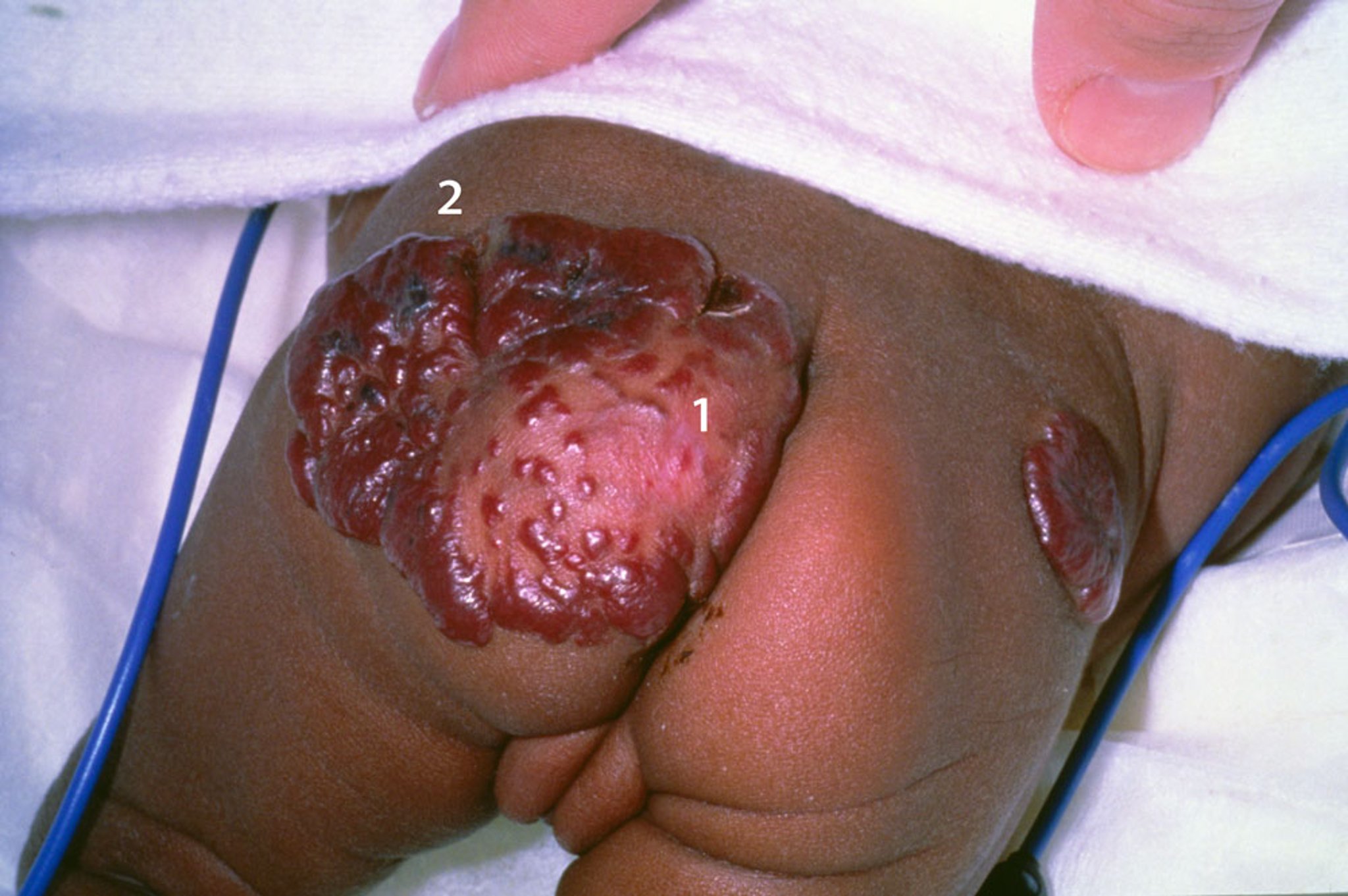 Infantile Hemangioma (Buttocks)