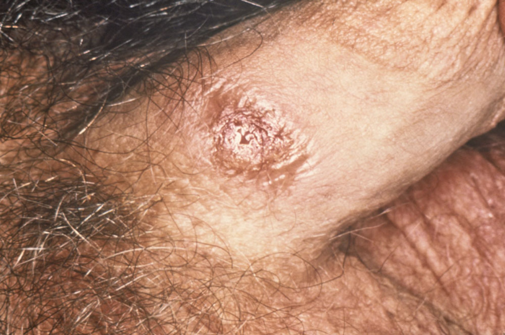 Primary Syphilis: Chancre on the Penis (1)