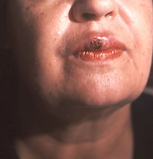 Sifilide primaria (sifiloma della bocca)