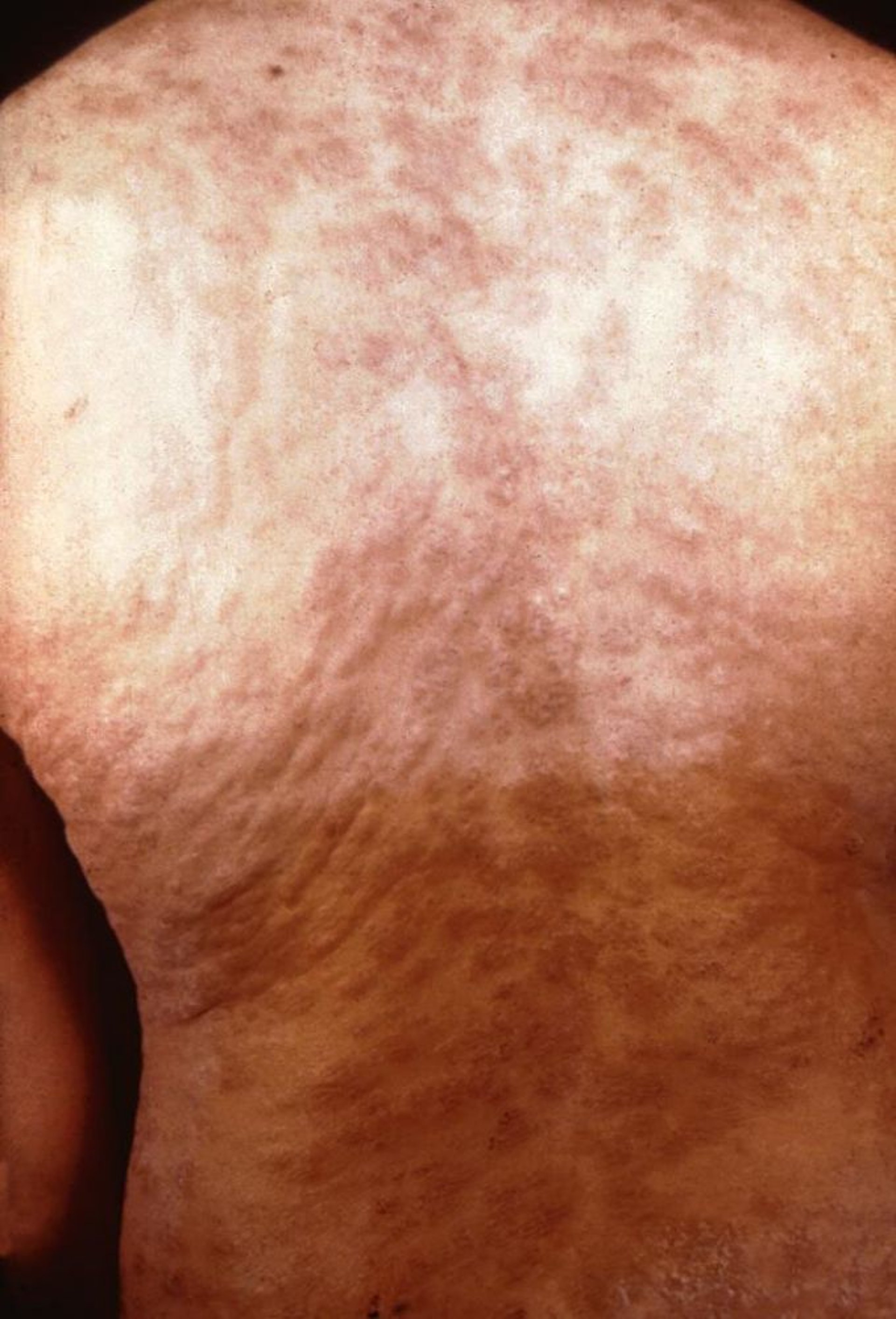 Сифилис — вторичный: сыпь на спине