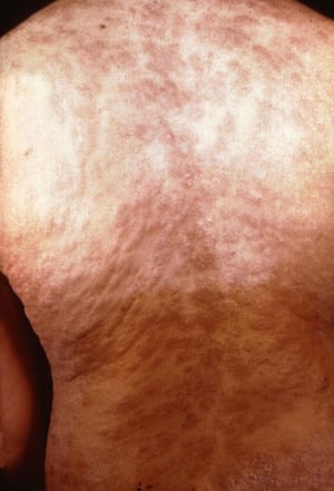 Syphilis—Secondary: Rash on the Back