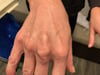 Xantomas tendinosos
