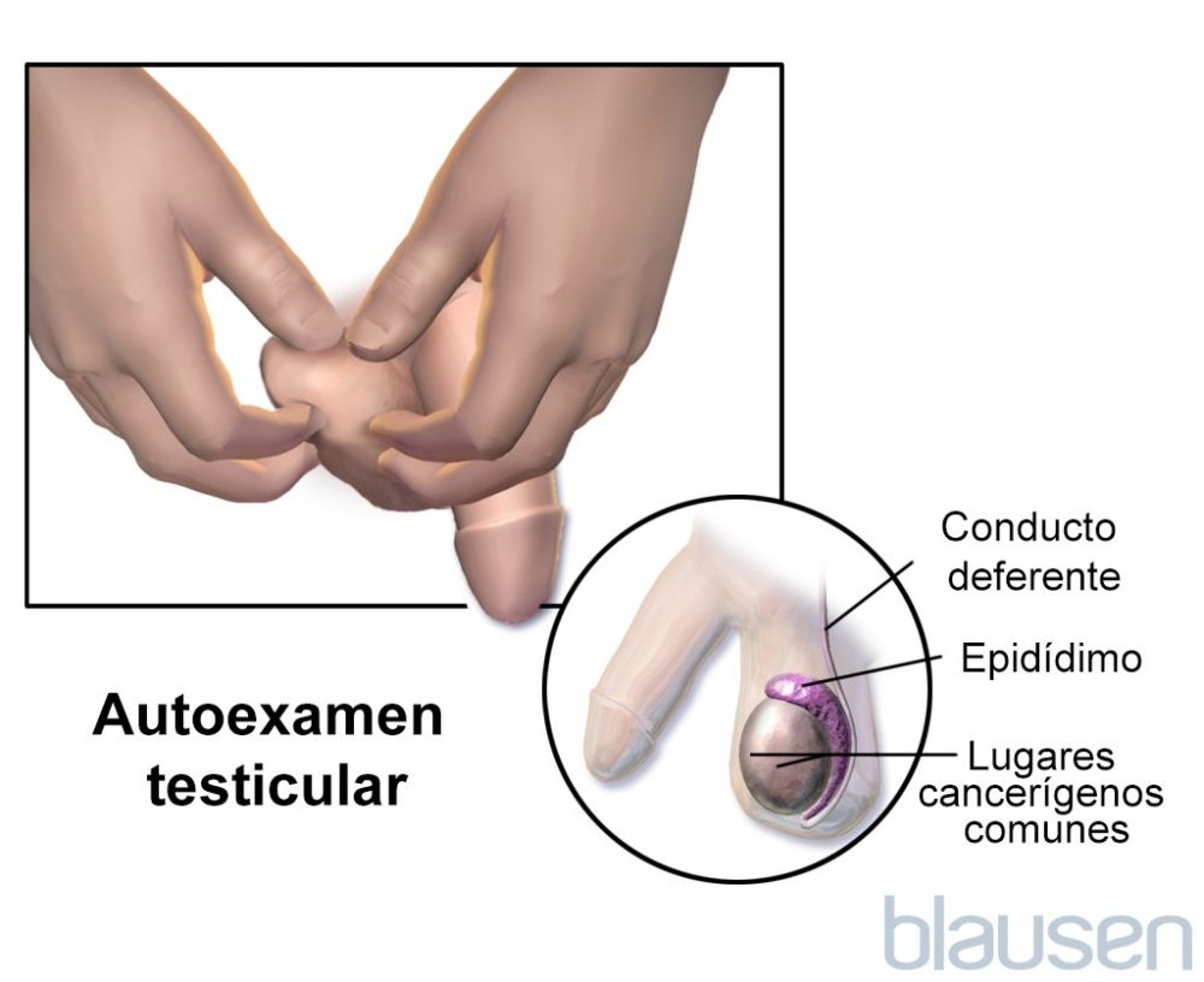 Autoexploración testicular