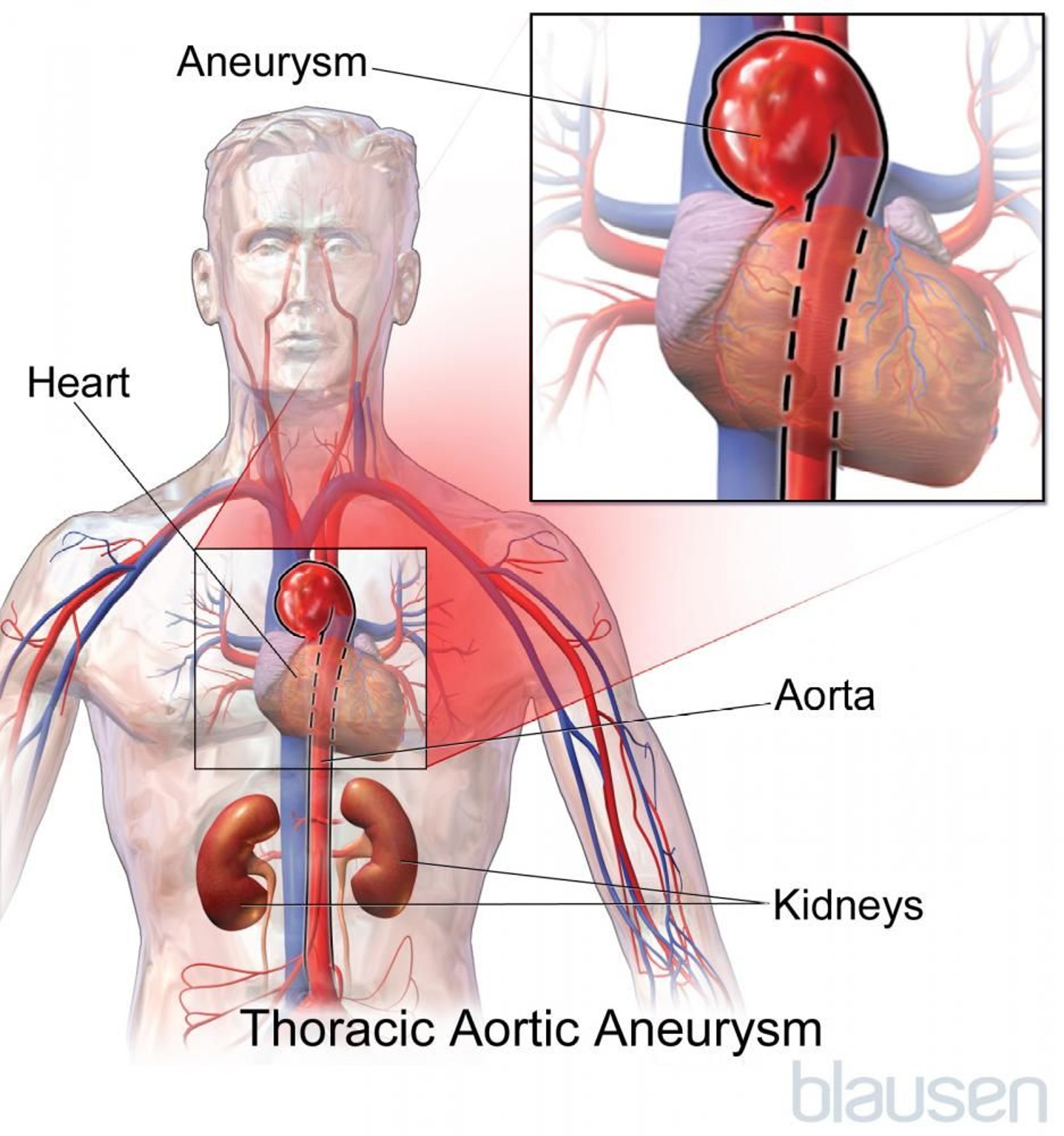 Thoracic Aortic Aneurysm