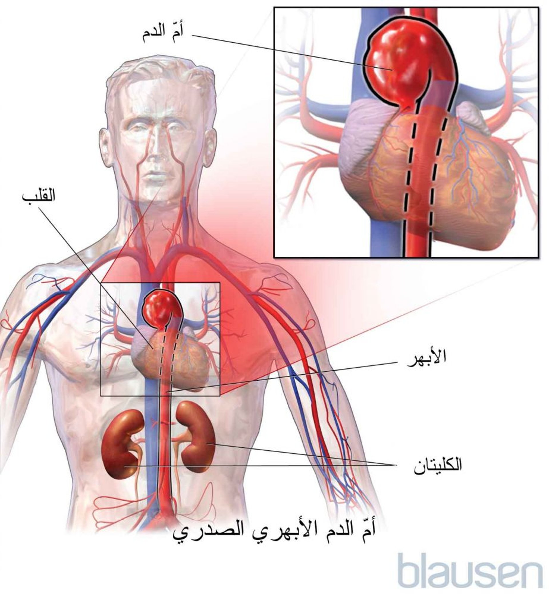 أم الدم الأبهرية الصدرية