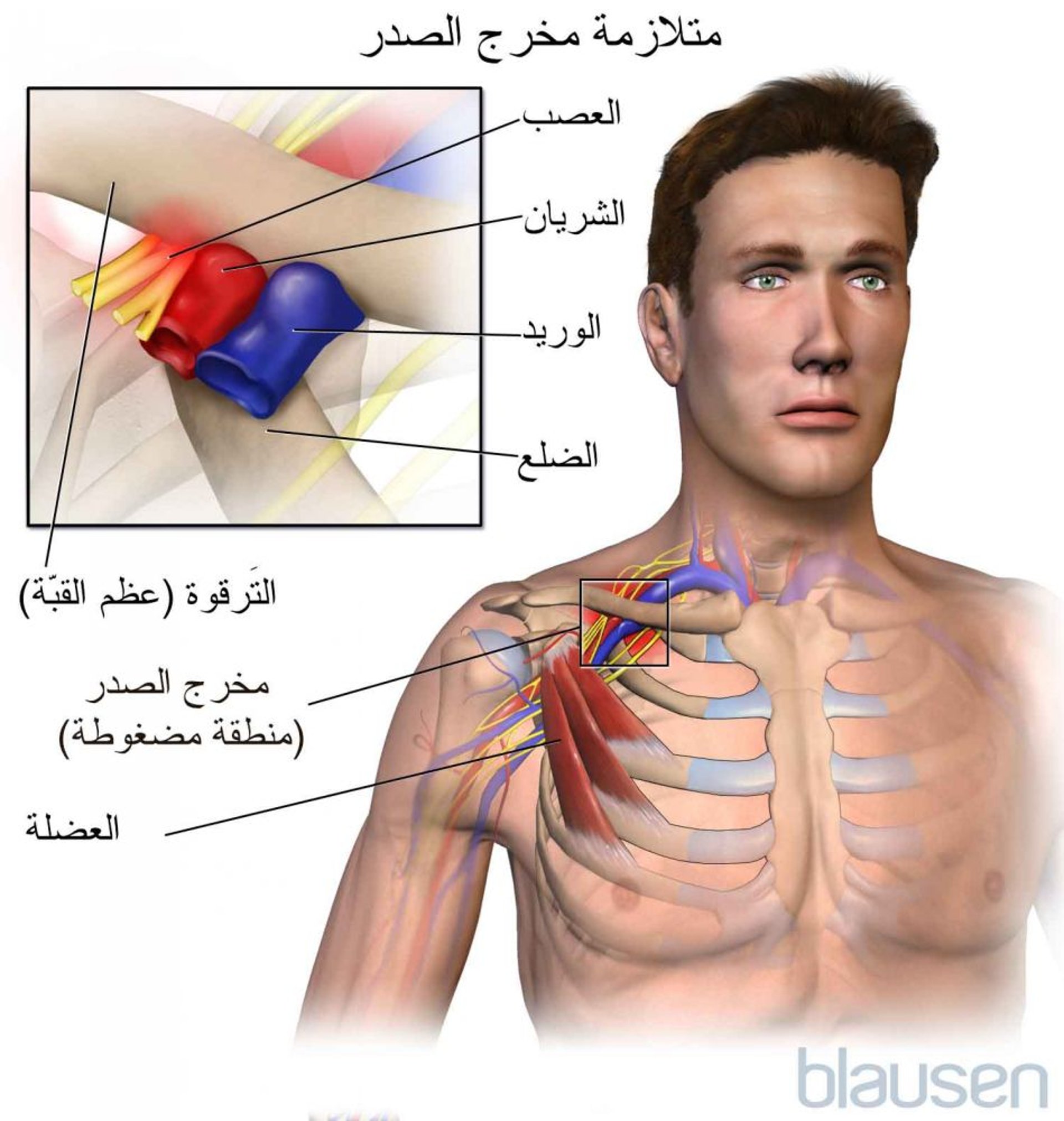 متلازمة مخرج الصدر