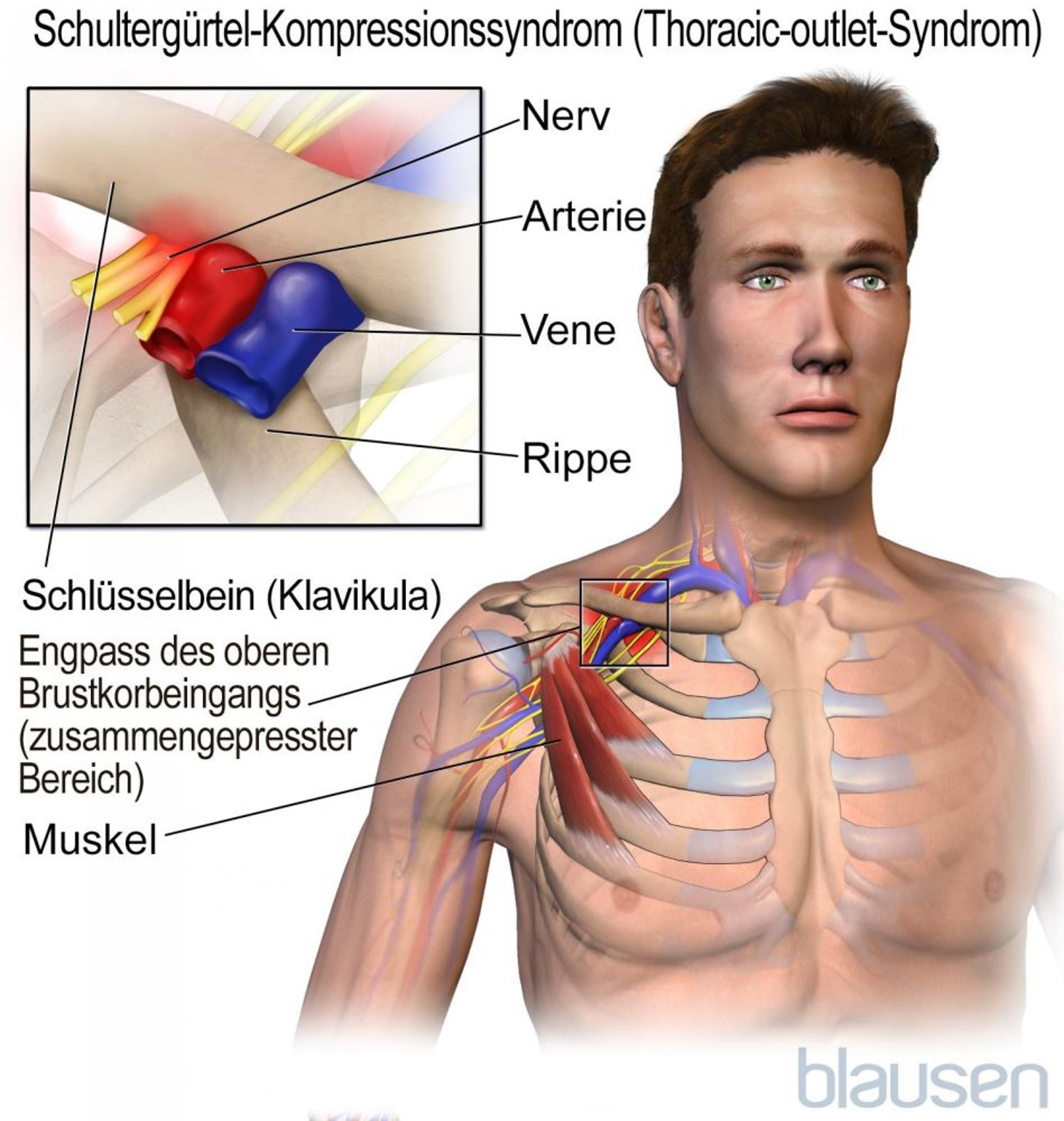 Schultergürtel-Kompressionssyndrom (Thoracic-outlet-Syndrom)