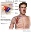 Syndrome du défilé thoracique