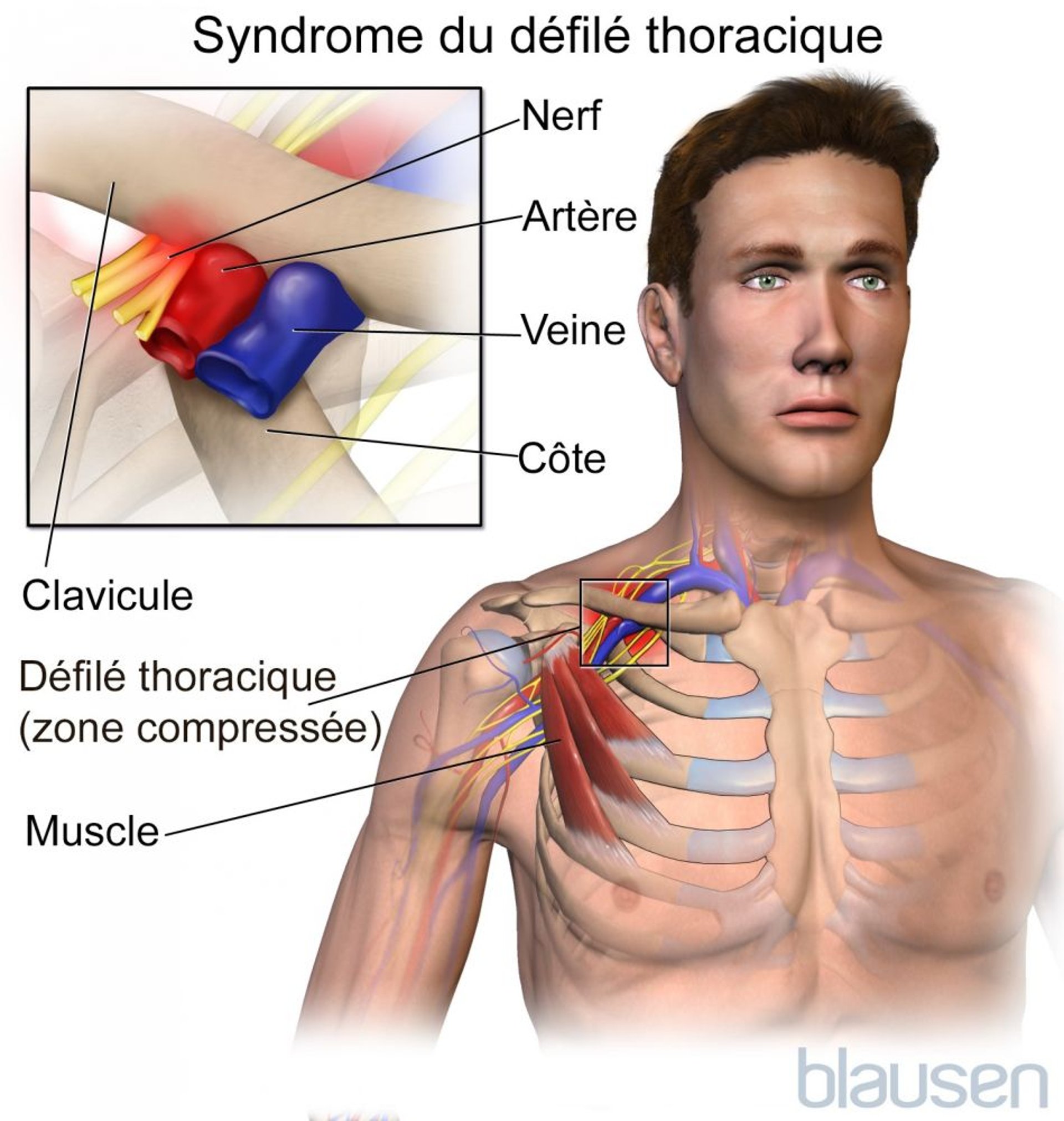 Syndrome du défilé thoracique
