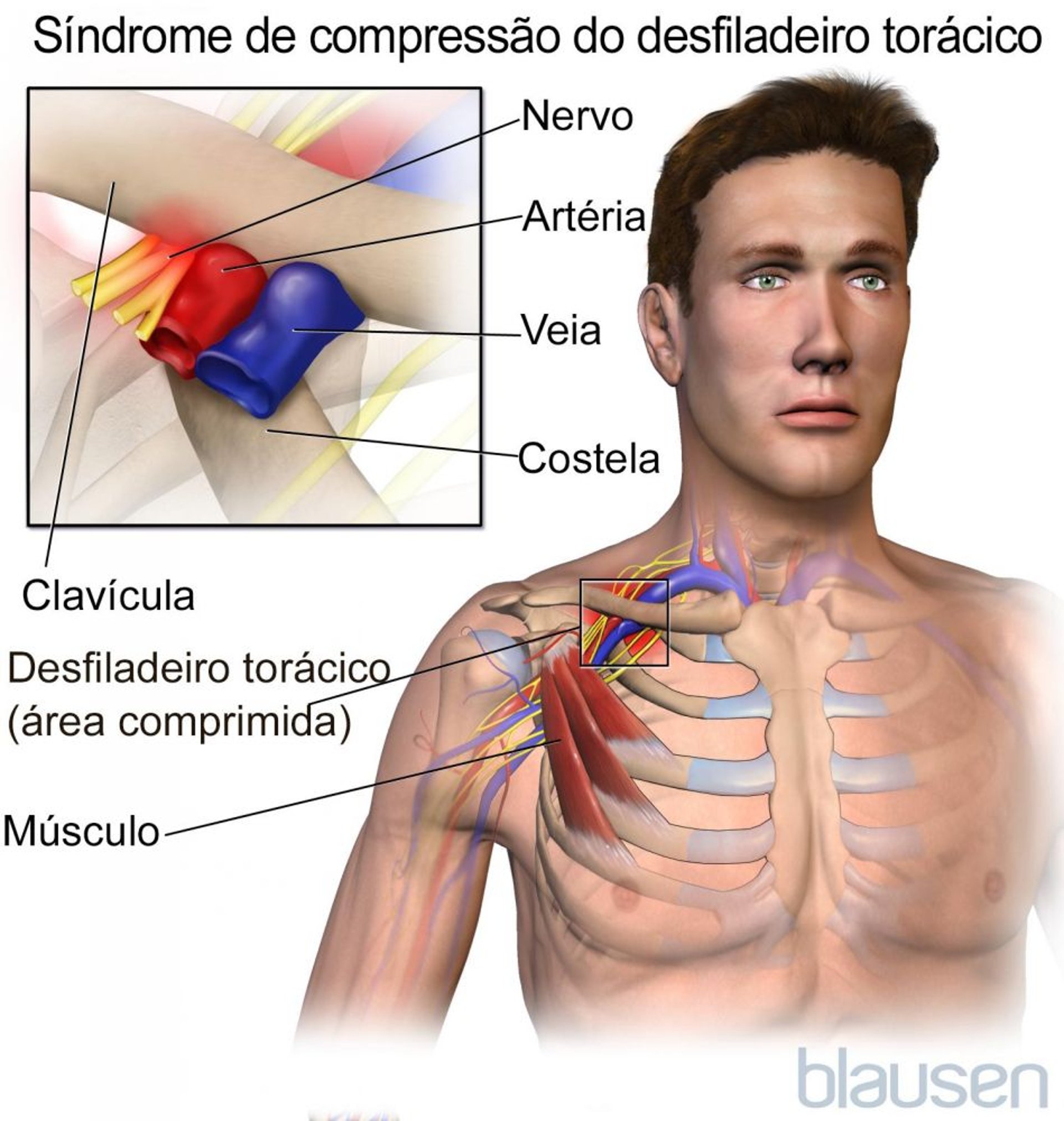 Síndrome de compressão do desfiladeiro torácico