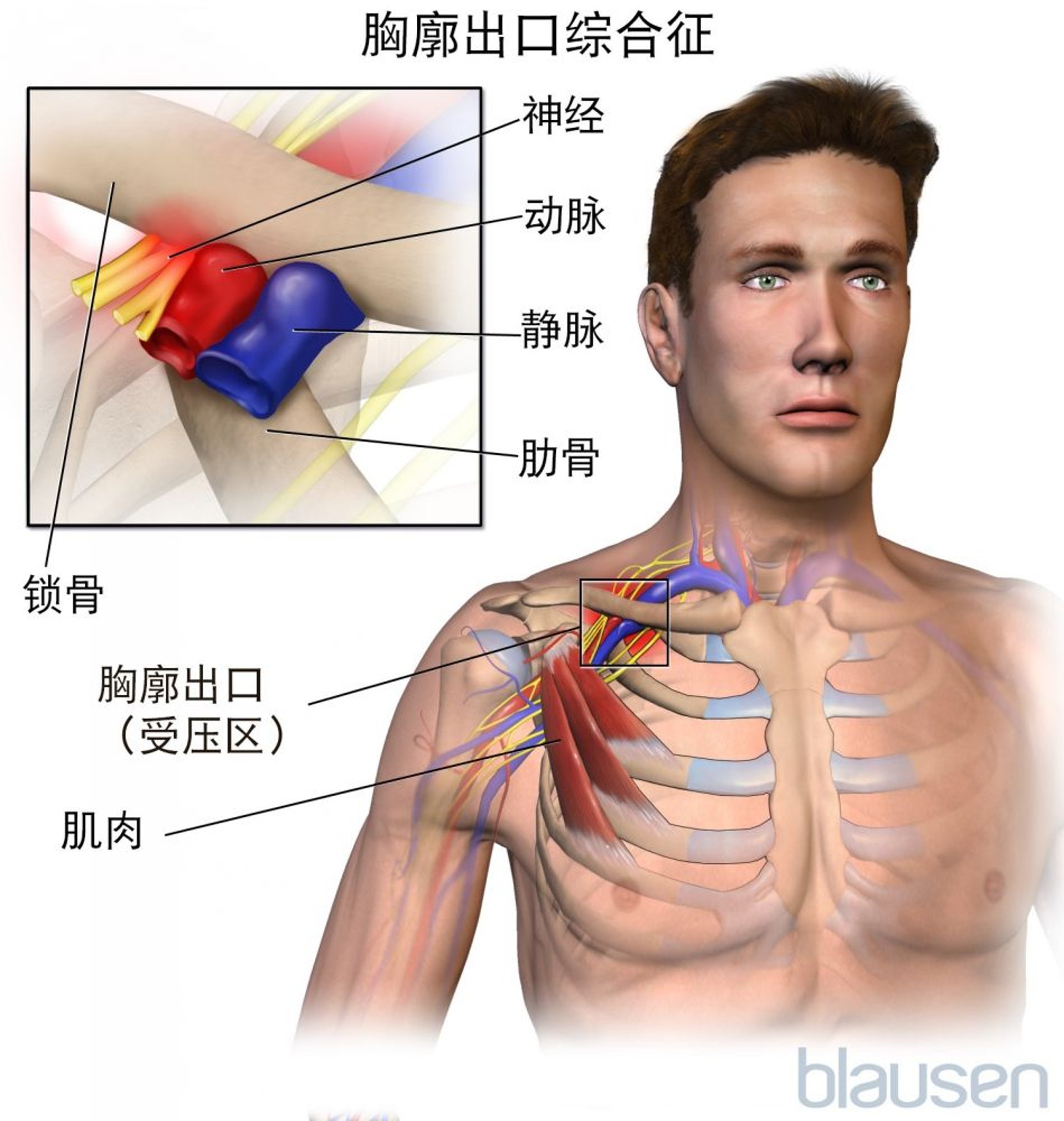 胸廓出口综合征