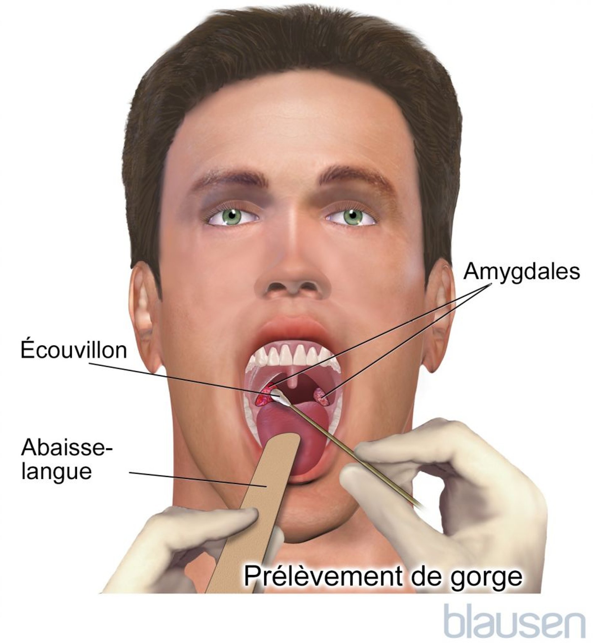 Prélèvement de gorge
