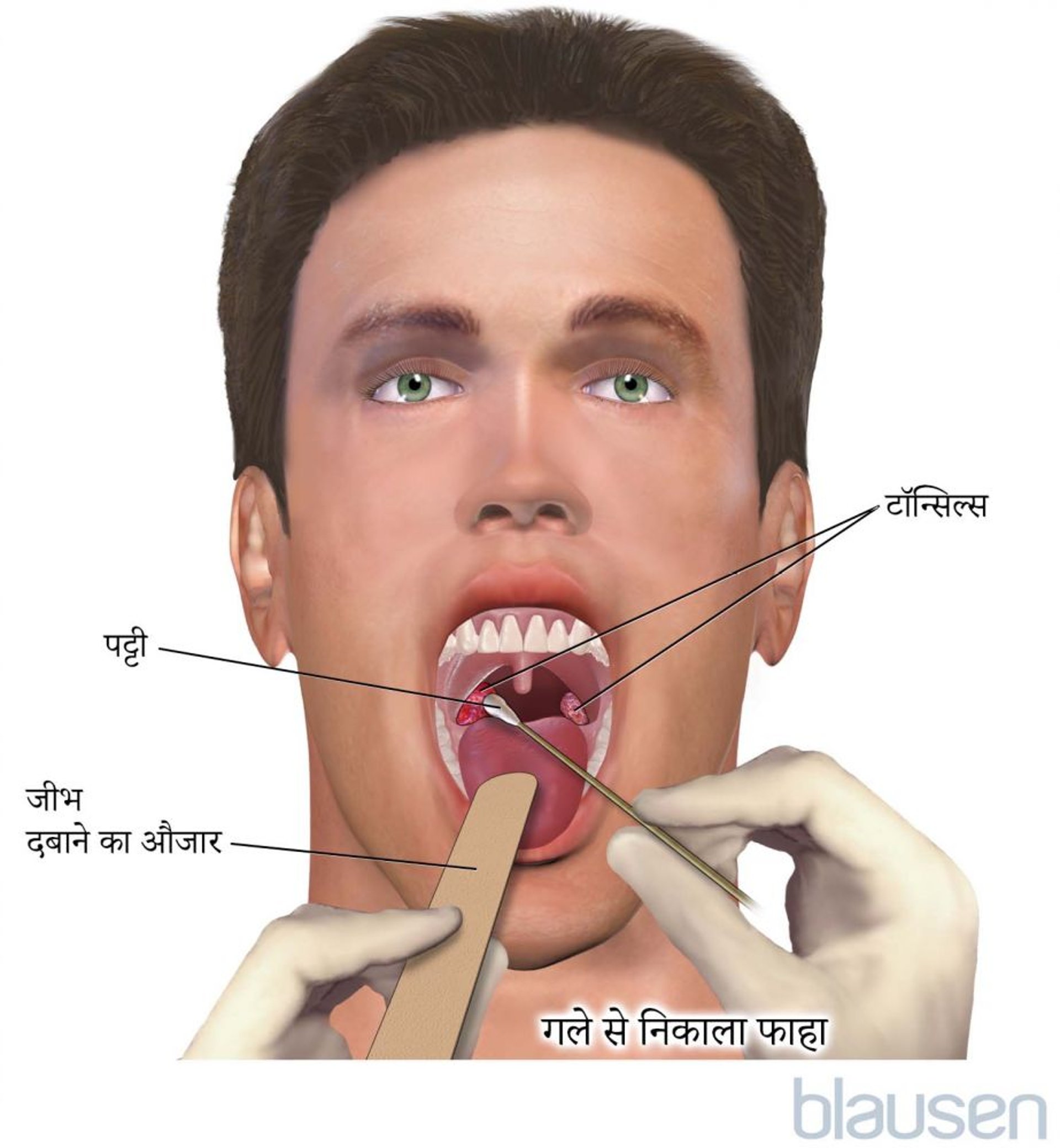 गले से निकाला फाहा
