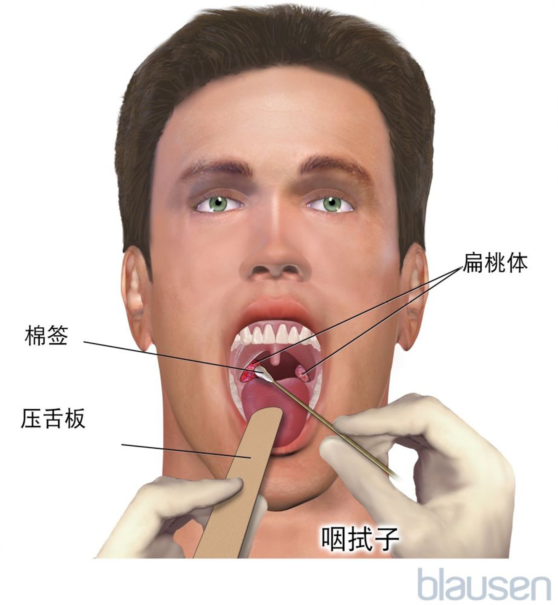 咽拭子