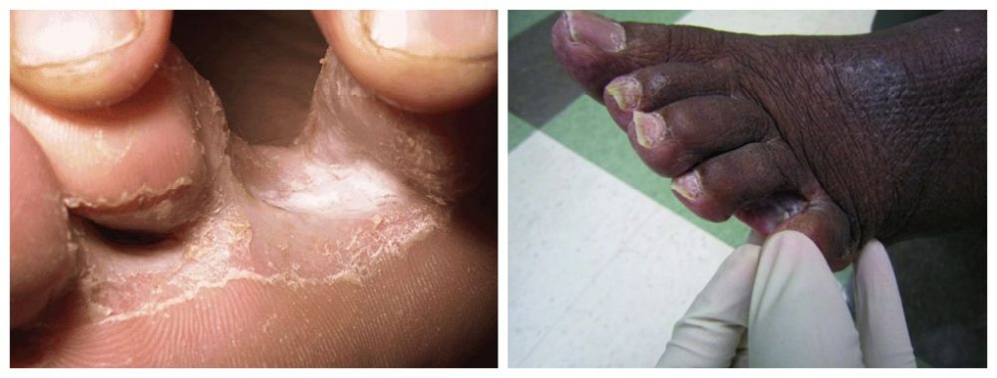 Pie de atleta (tinea pedis)