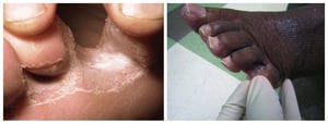 Pé de atleta (Tinea pedis)