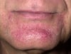 Teigne de la barbe (tinea barbae)