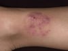 Tiña corporal (Tinea corporis)