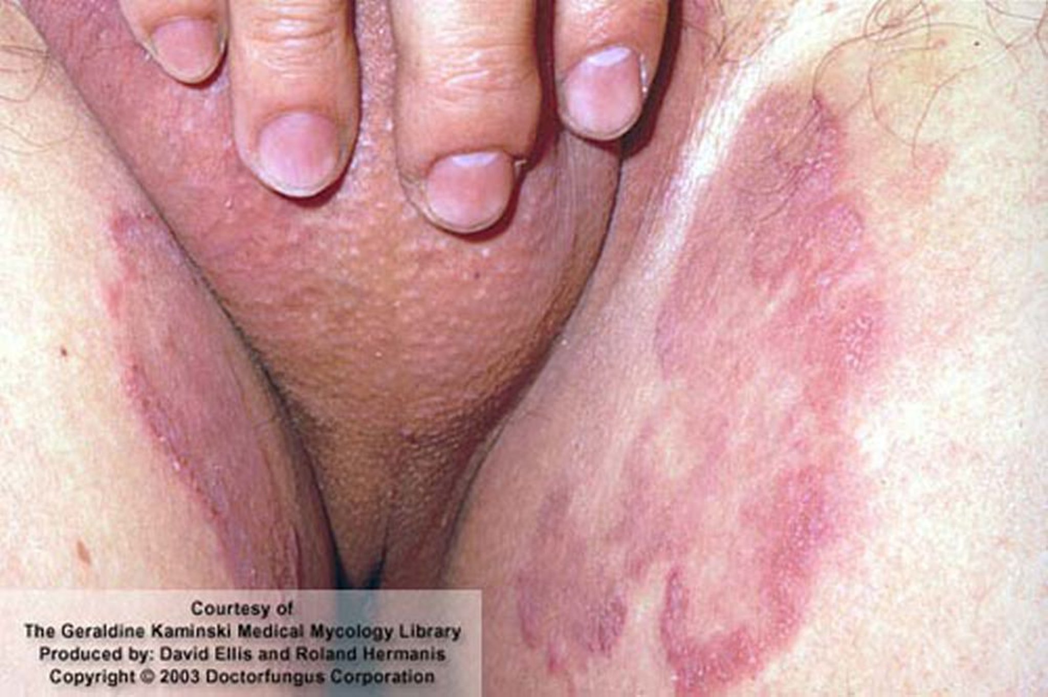 Eczéma marginé de Hebra (tinea cruris)