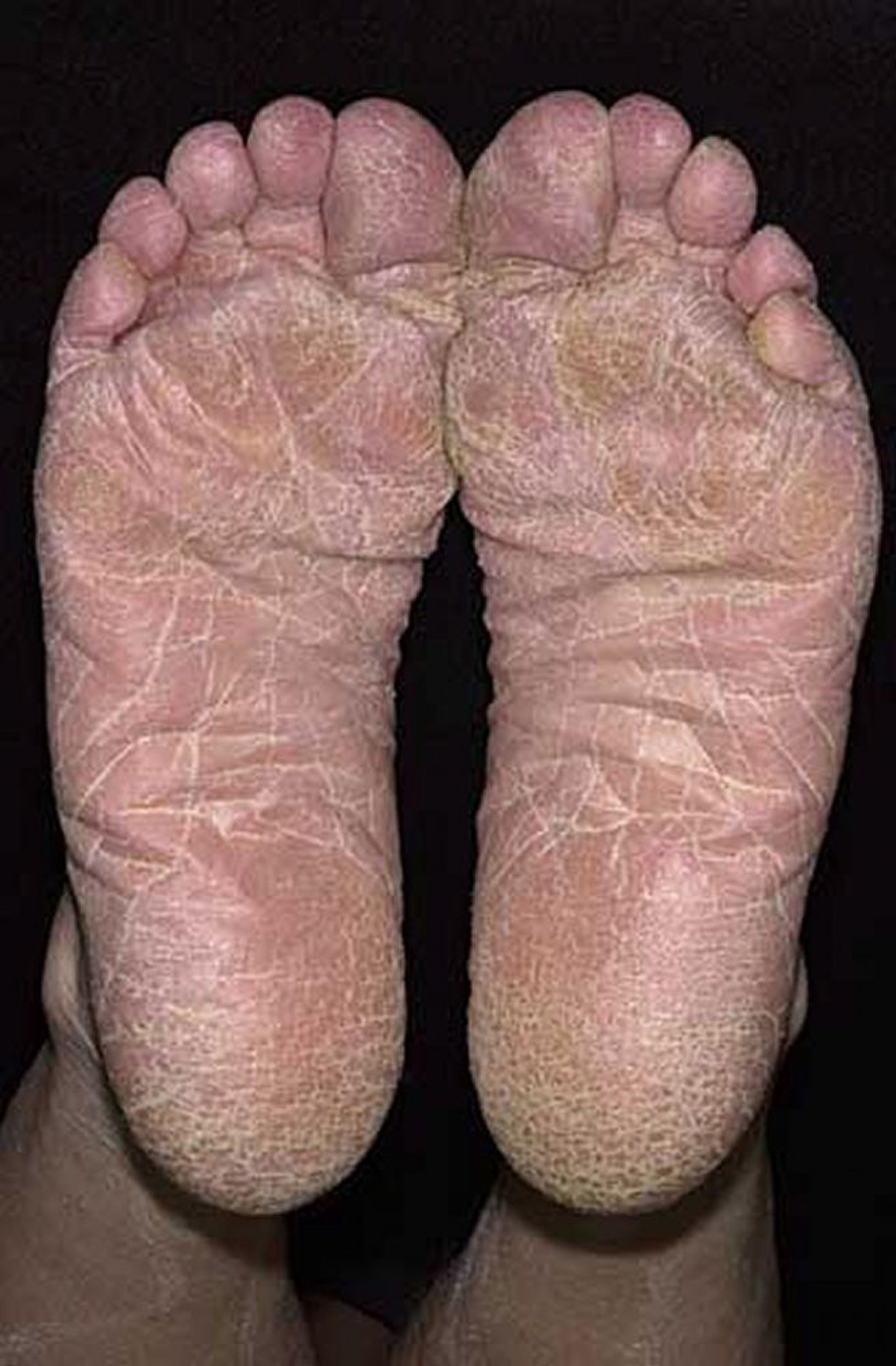 Descamação da planta do pé inteira no pé de atleta (Tinea pedis)
