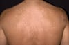 Tinea versicolor am Rücken