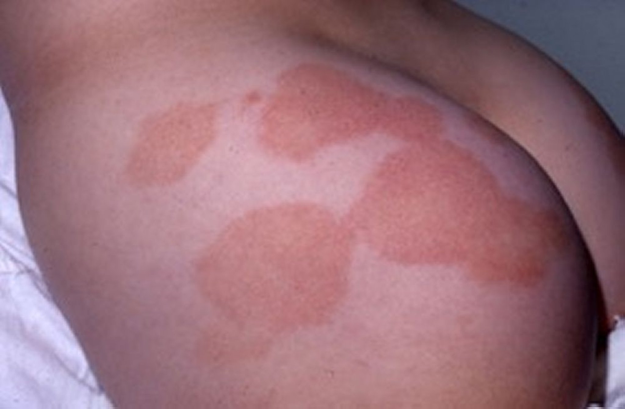 Large-Plaque Parapsoriasis on the Buttocks