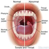 Normal and Abnormal Tonsils and Throat