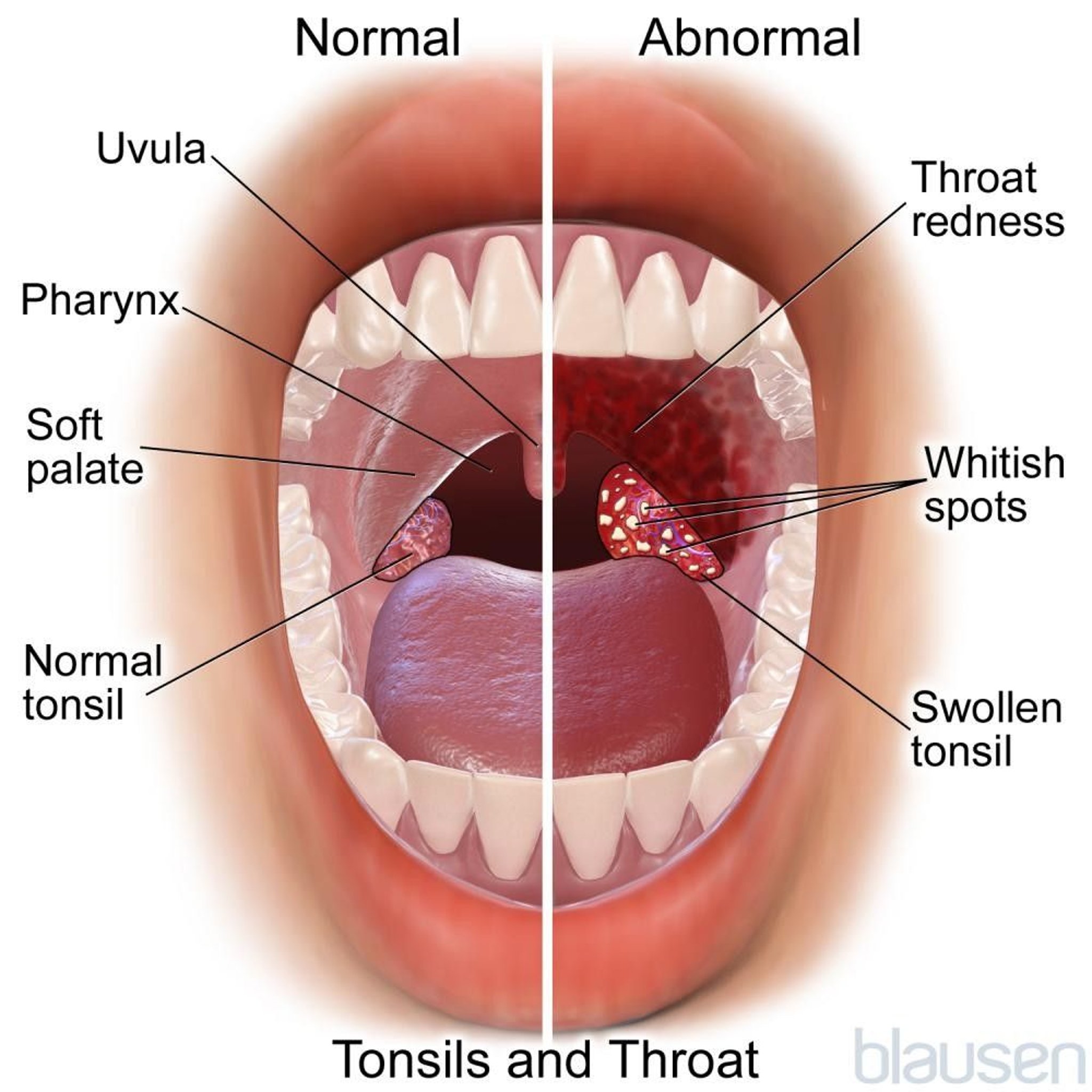 Normal and Abnormal Tonsils and Throat