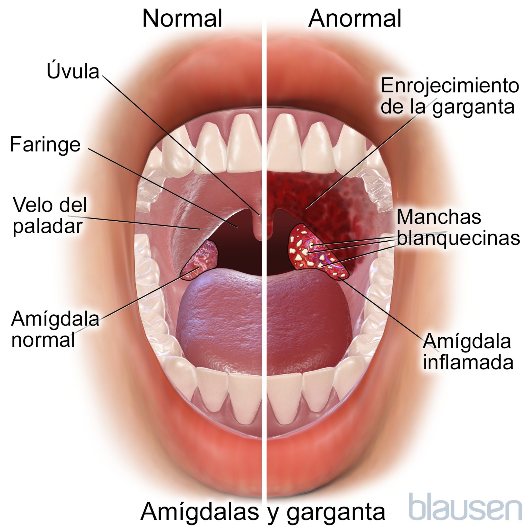 Amígdalas y garganta normales y anormales