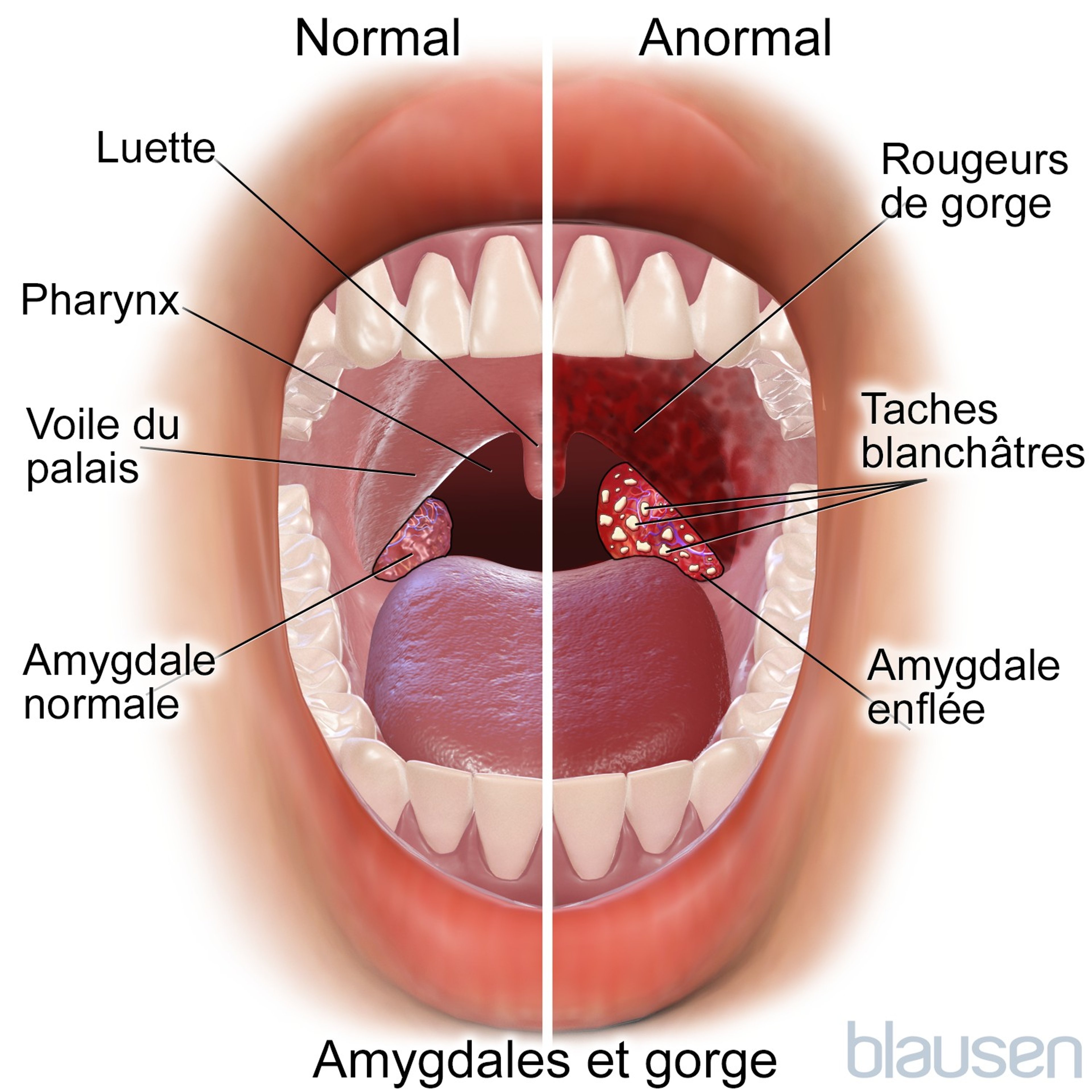 Gorge et amygdales normales et anormales