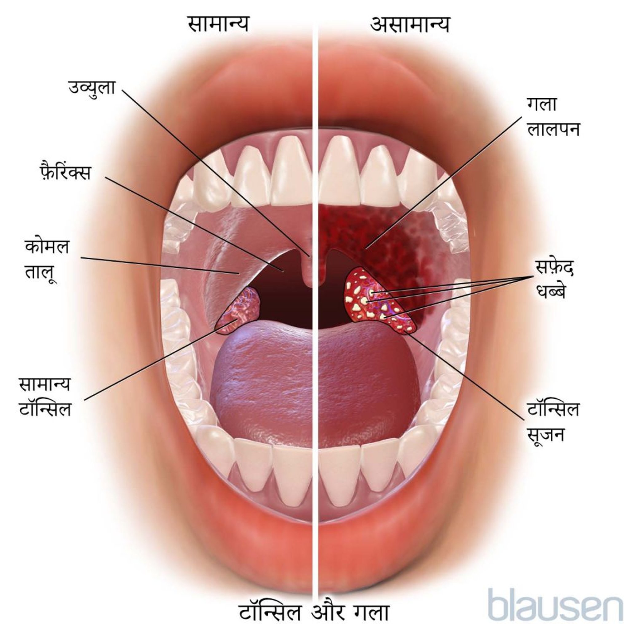 सामान्य और असामान्य टॉन्सिल और गला