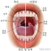 정상과 비정상 편도와 인후