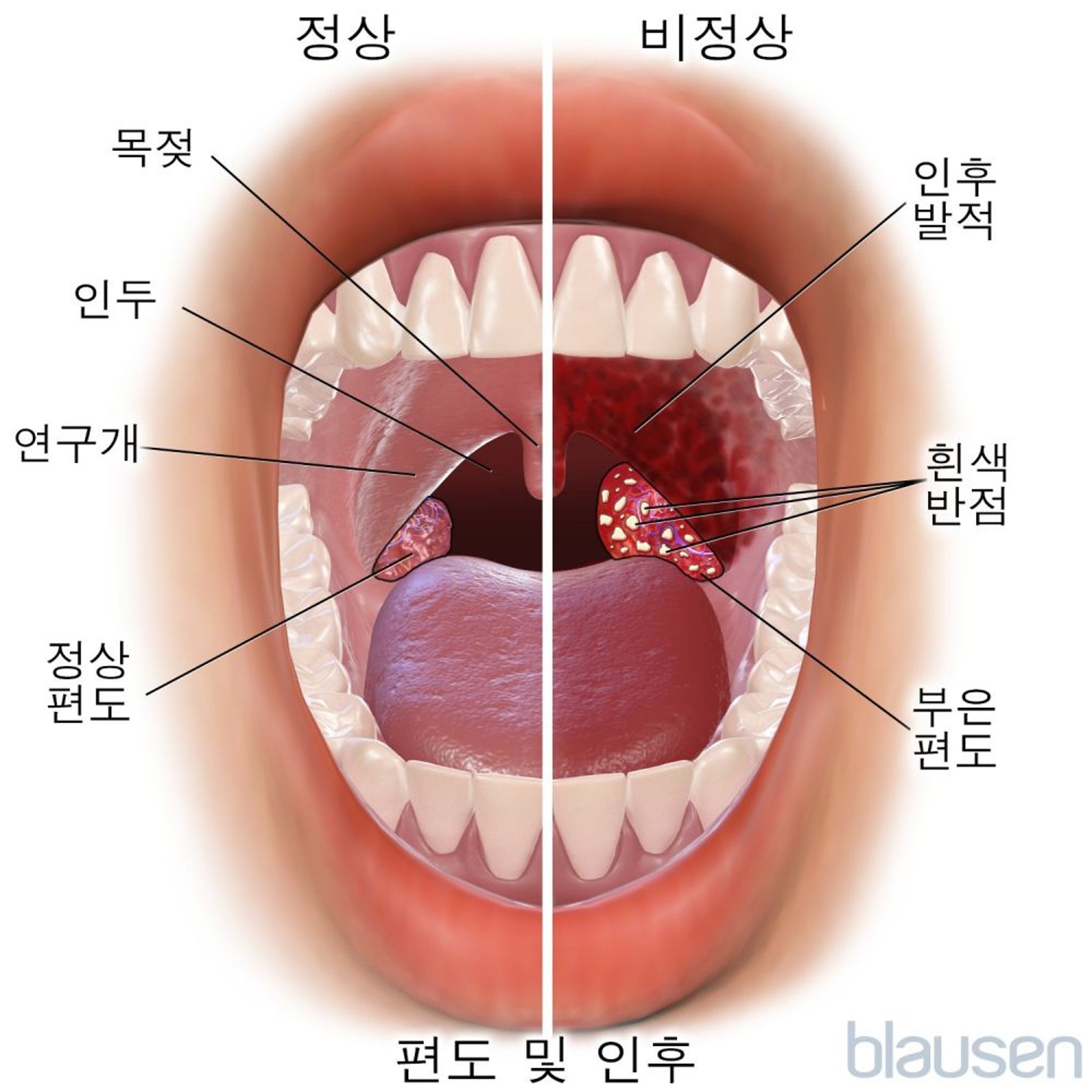 정상과 비정상 편도와 인후