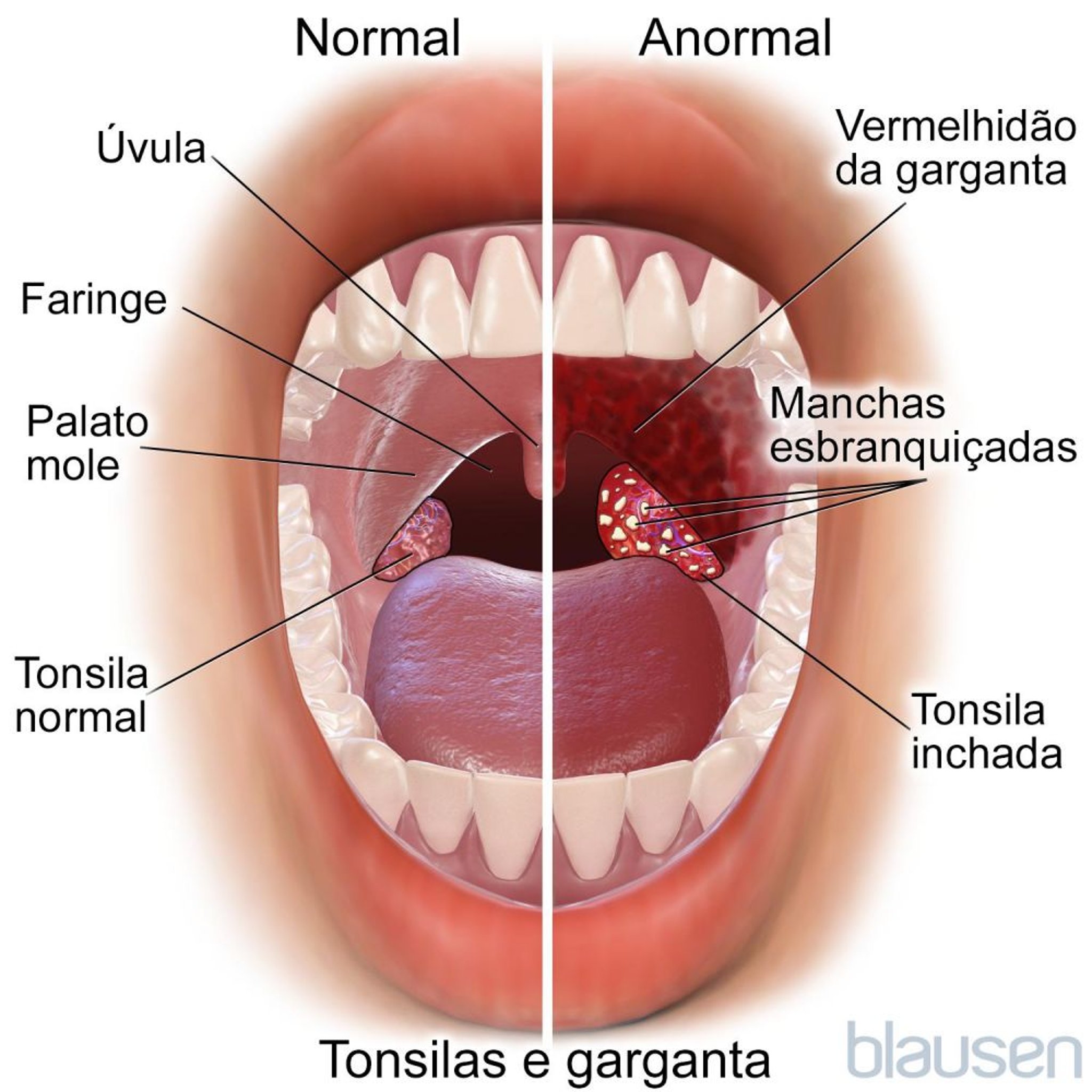 Amígdalas e garganta normal e anormal