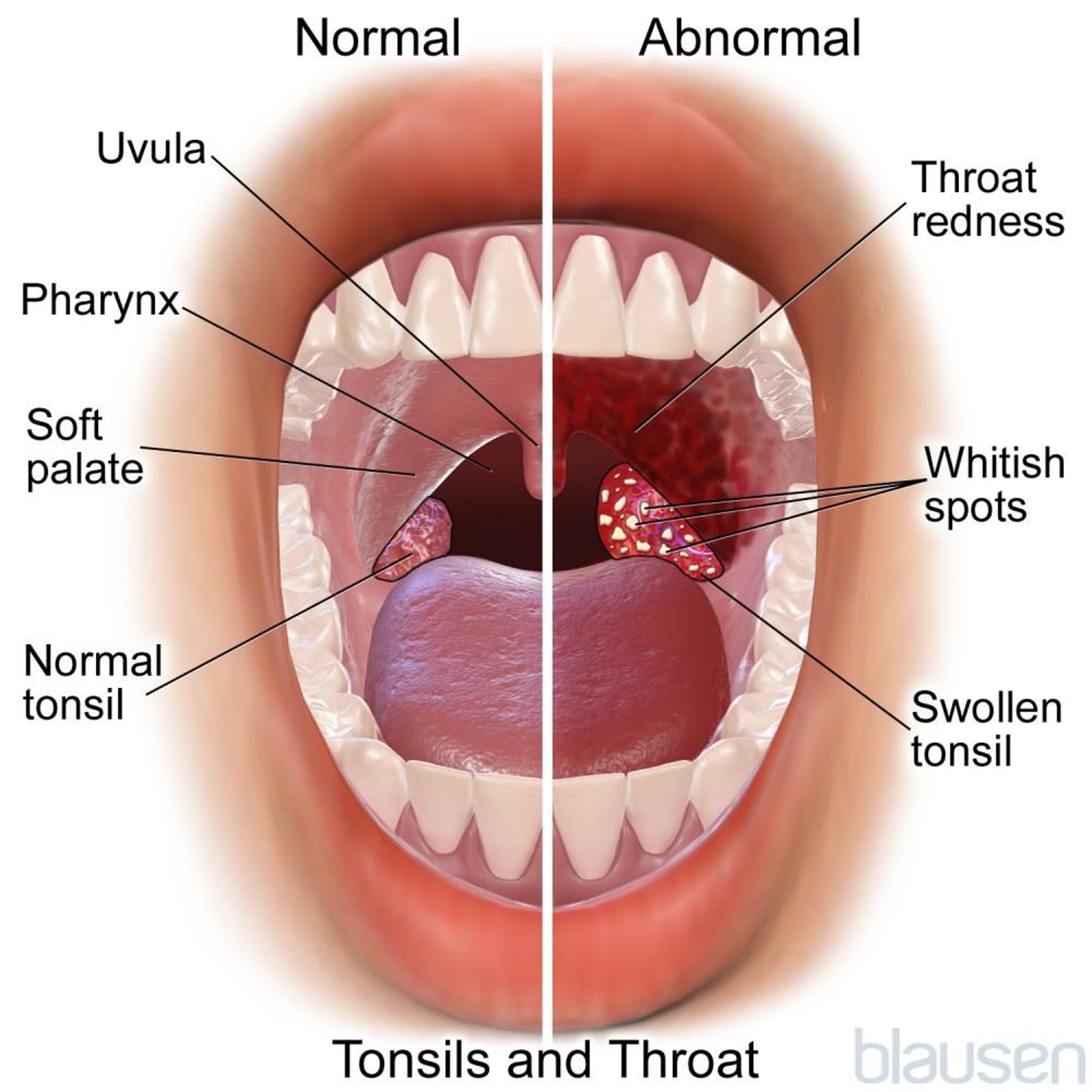 正常和异常的扁桃体和咽喉