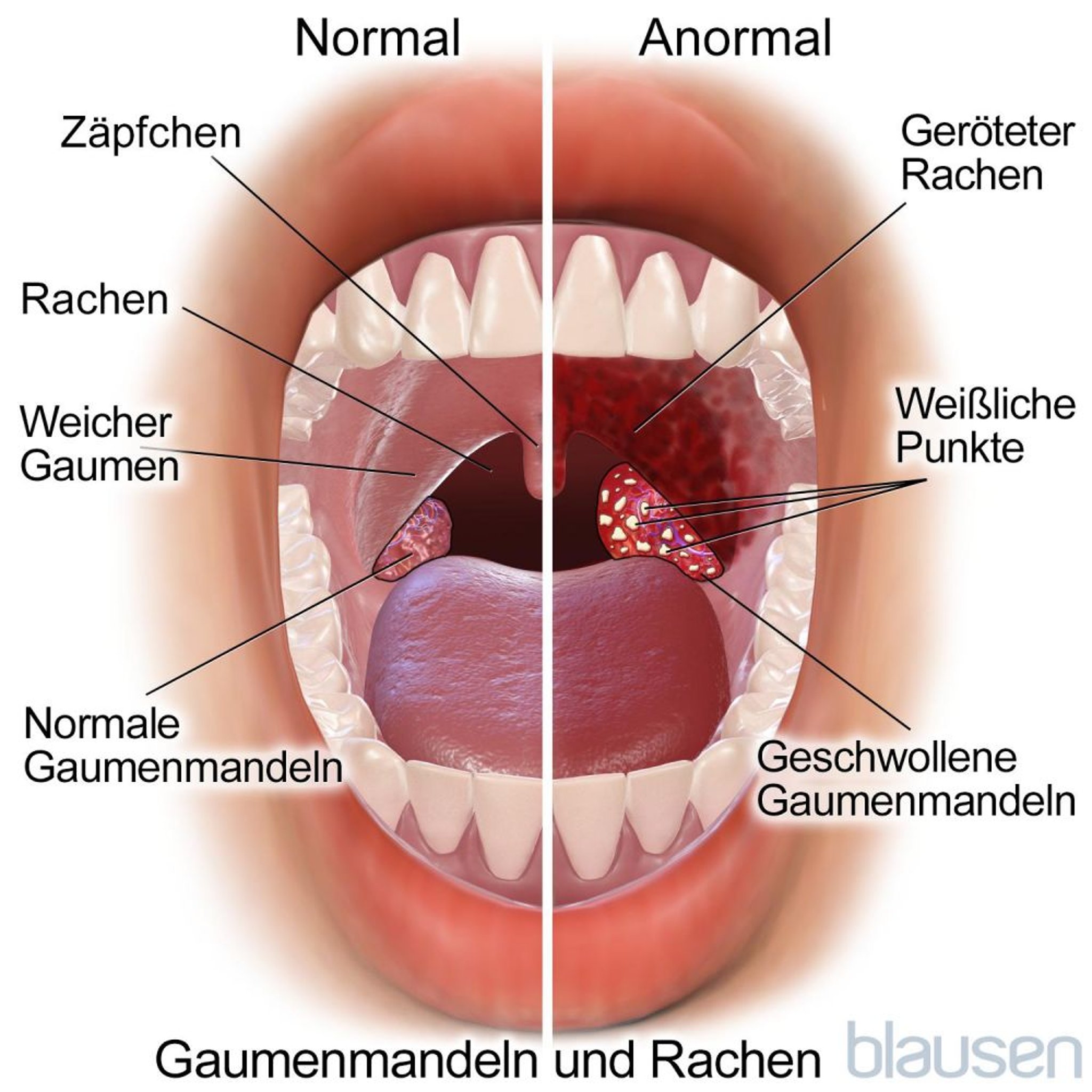 Normale und auffällige Mandeln und Rachen