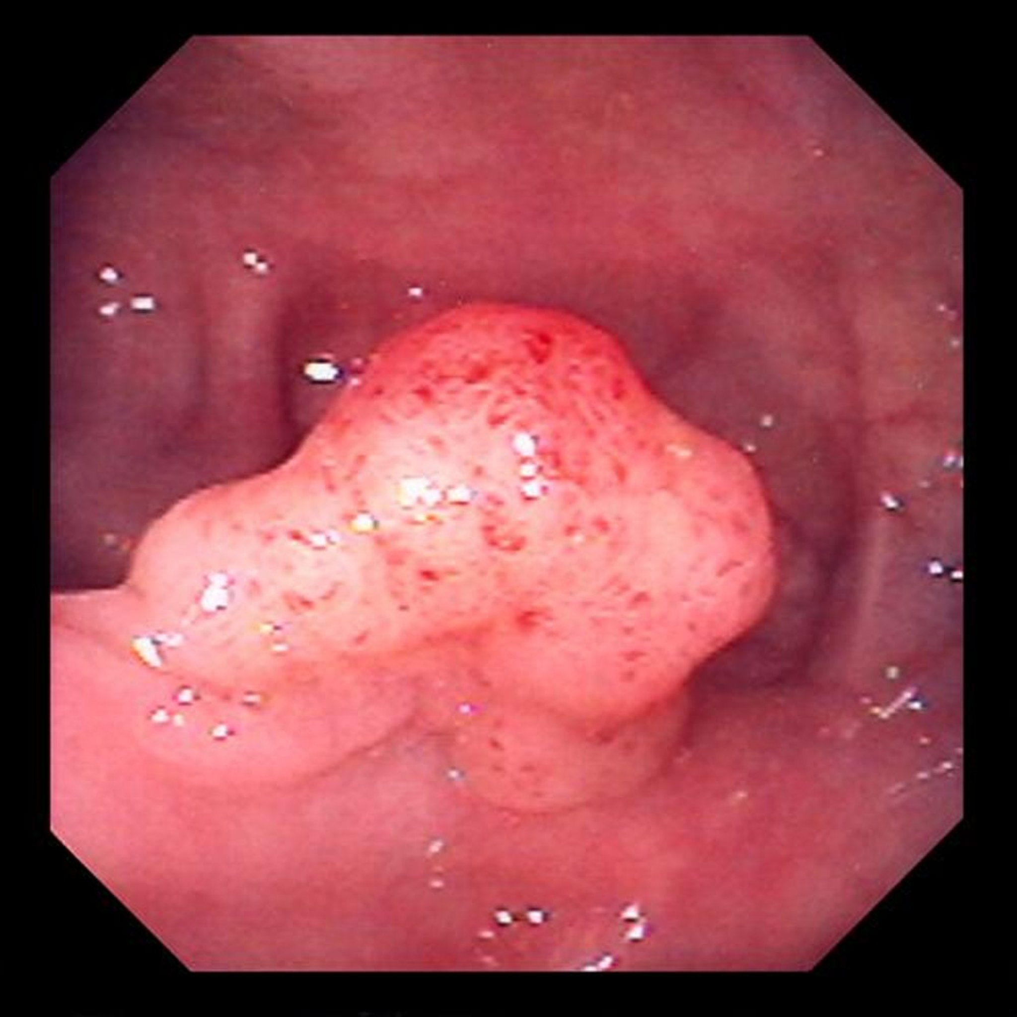 ट्यूबलोविल्लस एडेनोमा