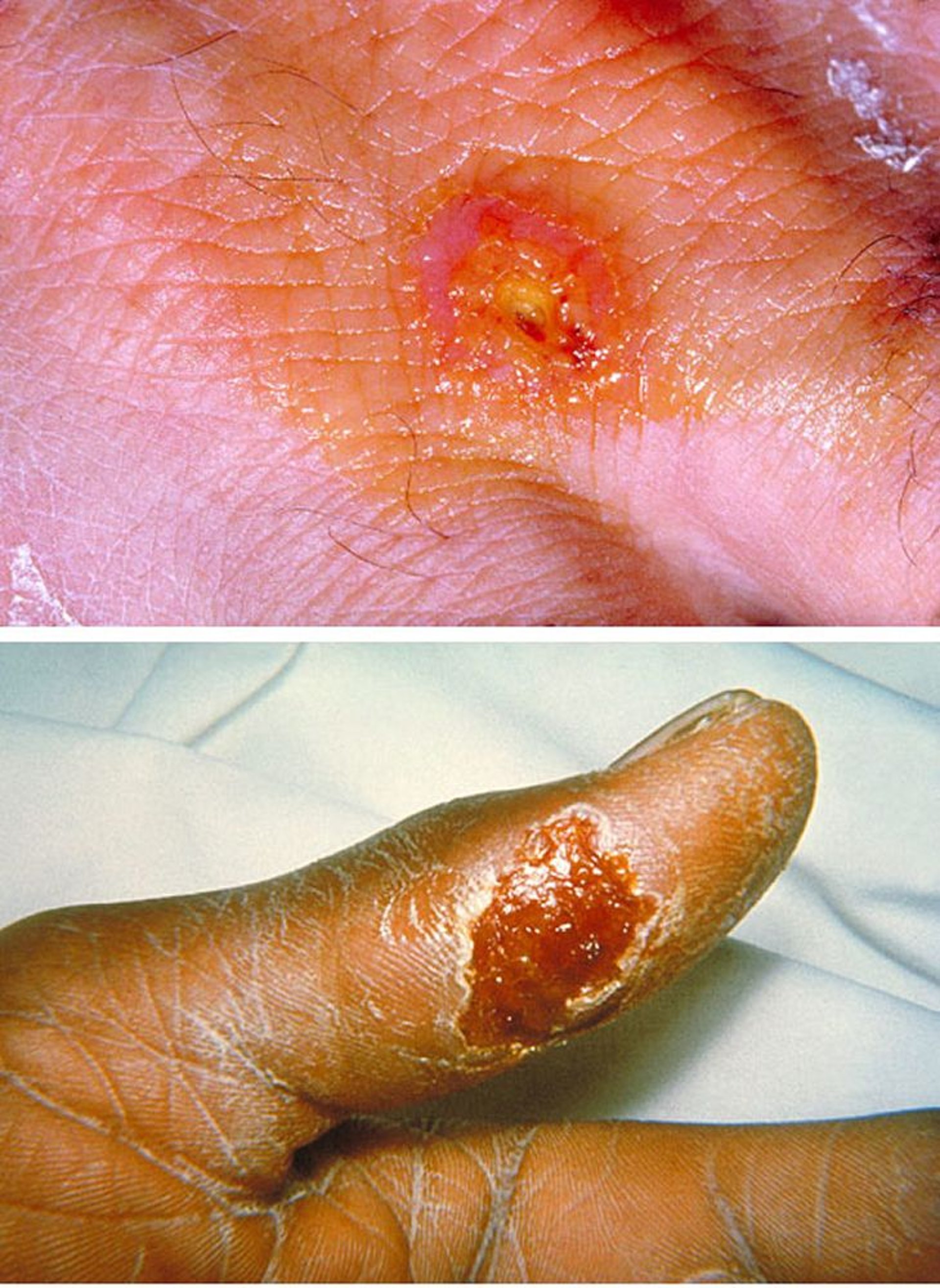 Feridas na pele causadas por tularemia