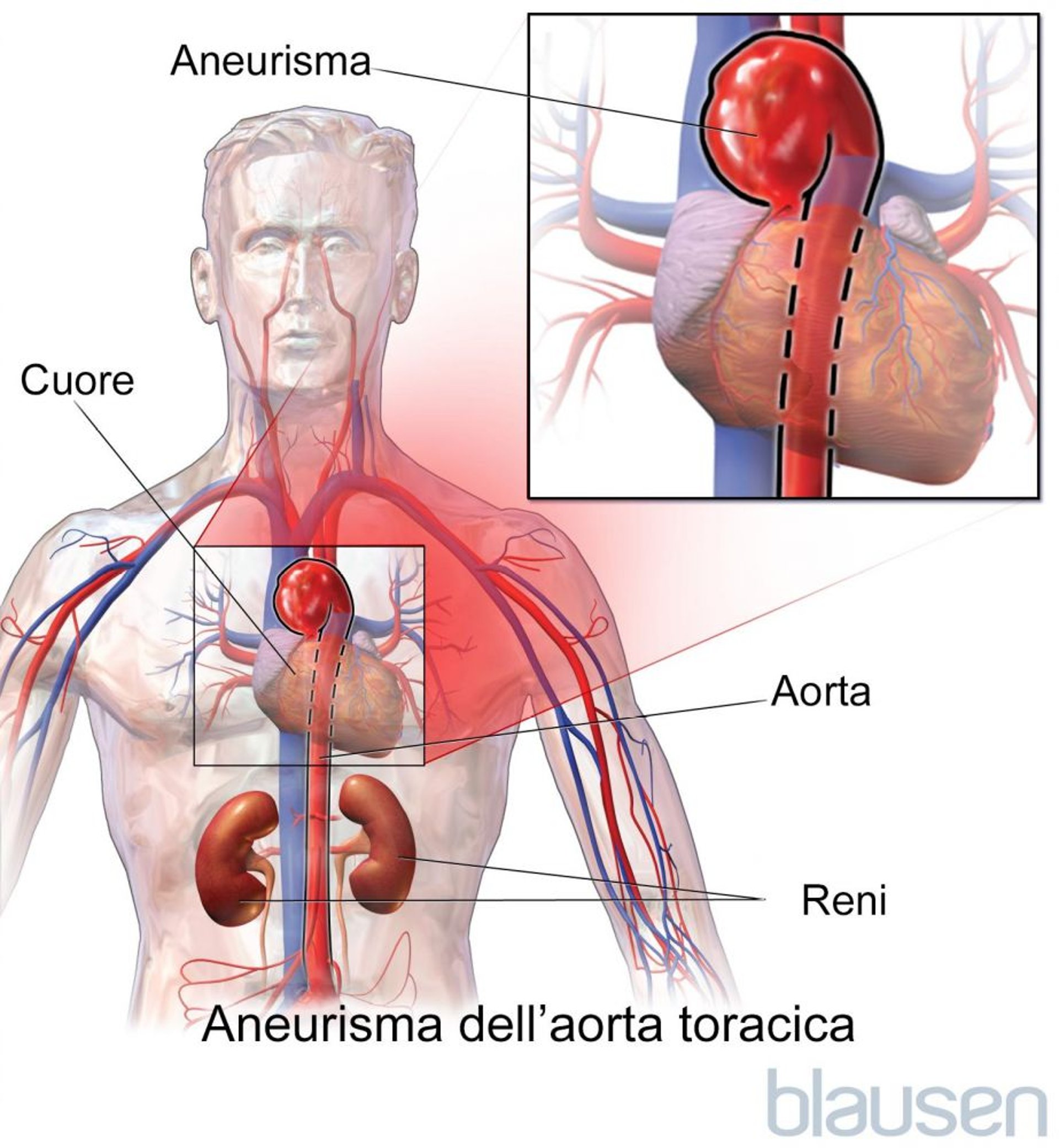 Aneurisma dell’aorta toracica