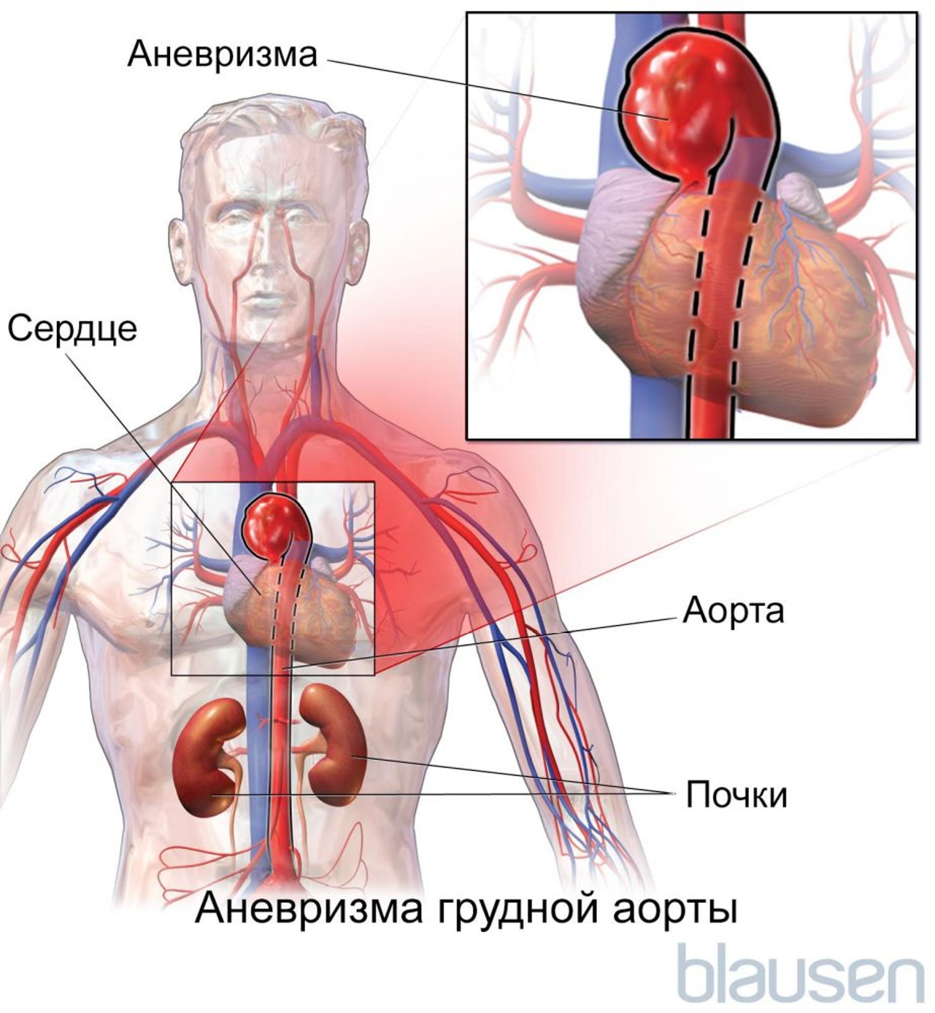 Аневризма грудной аорты