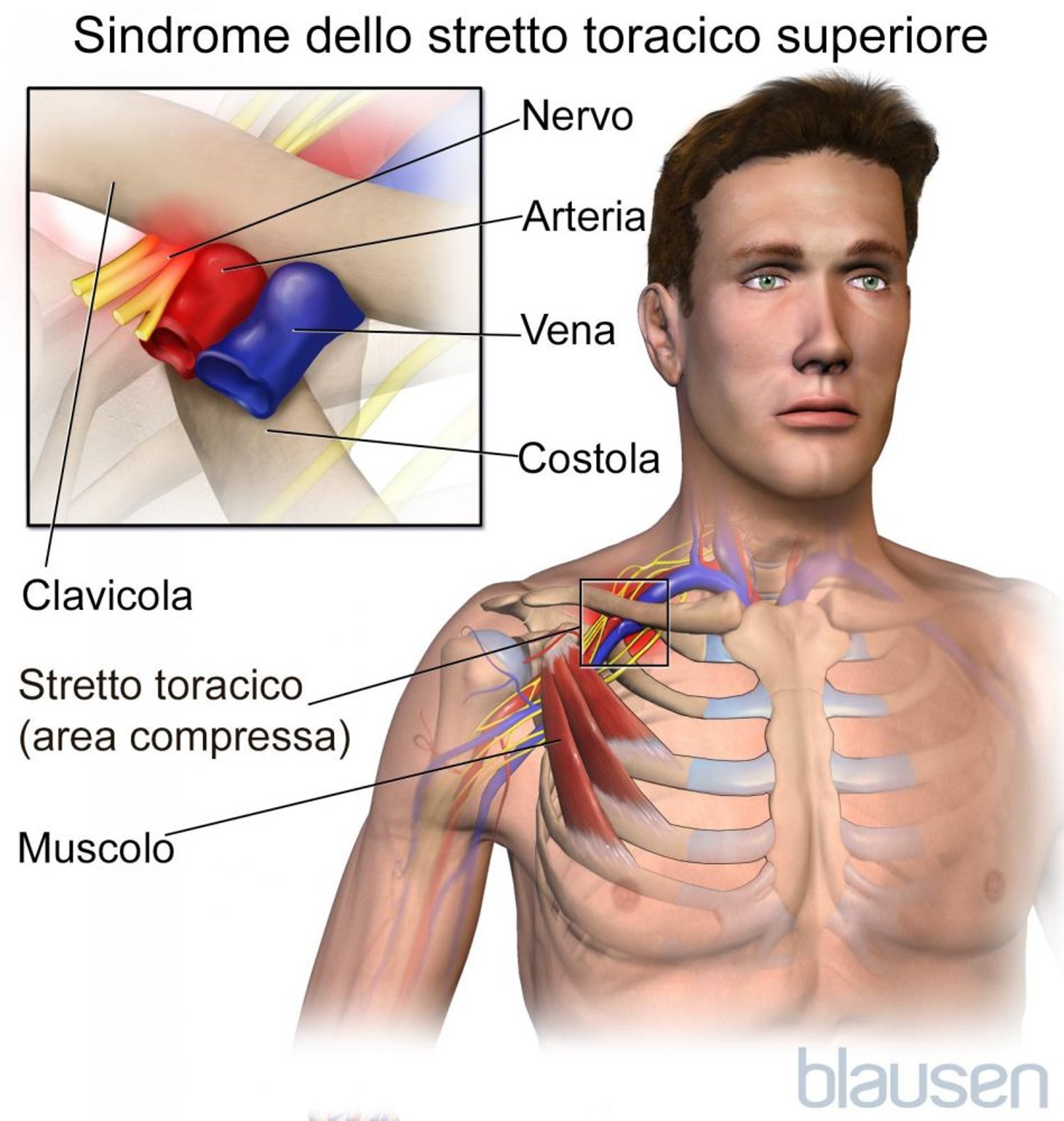 Sindrome dello stretto toracico superiore