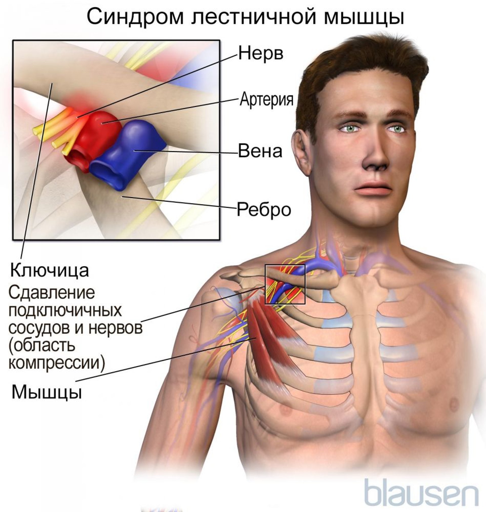 Синдром верхней апертуры грудной клетки