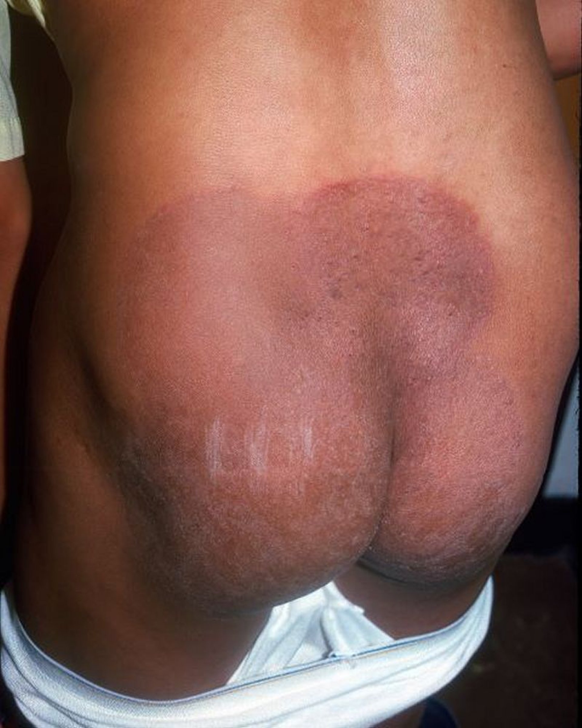 Tiña corporal (Tinea corporis) en las nalgas