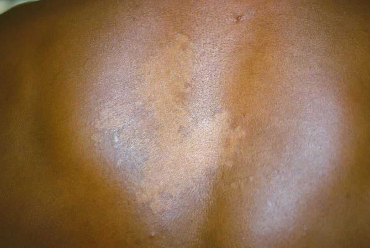 Tinea versicolor sulla schiena