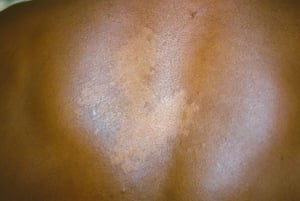 Tinea versicolor sulla schiena