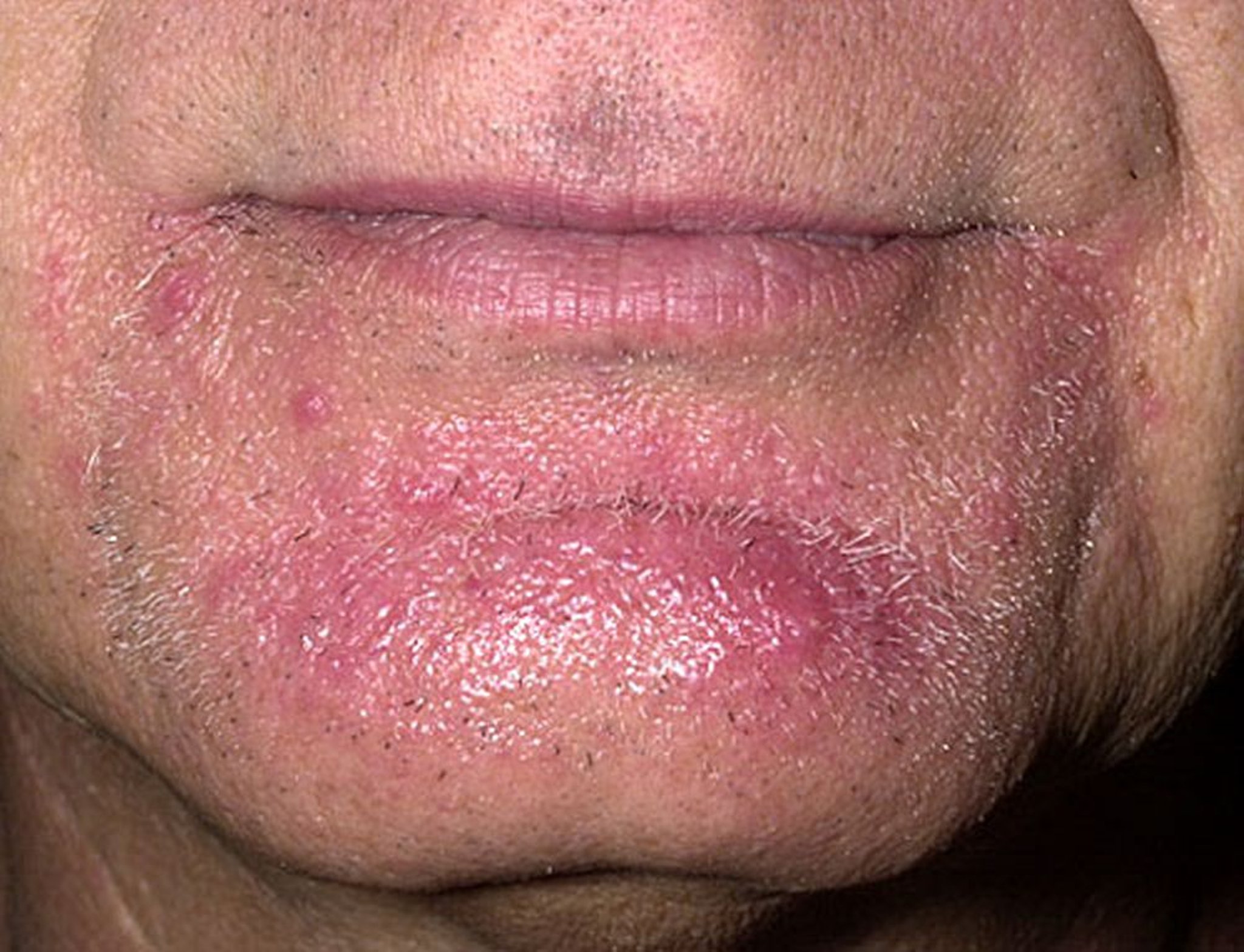 Tigna della barba (tinea barbae)