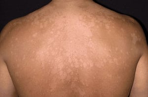 Tinea Versicolor Mgongoni (2)