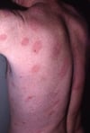 Parapsoriasis ya Utando Mkubwa kwenye Kiwiliwili