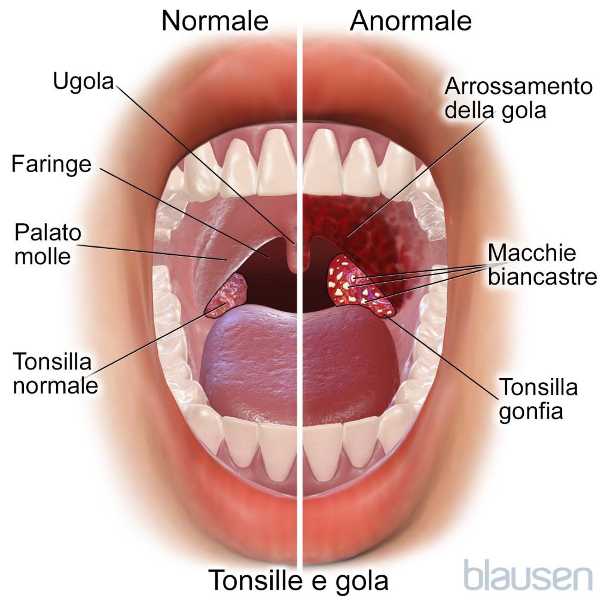 Tonsille e gola normali e anomale