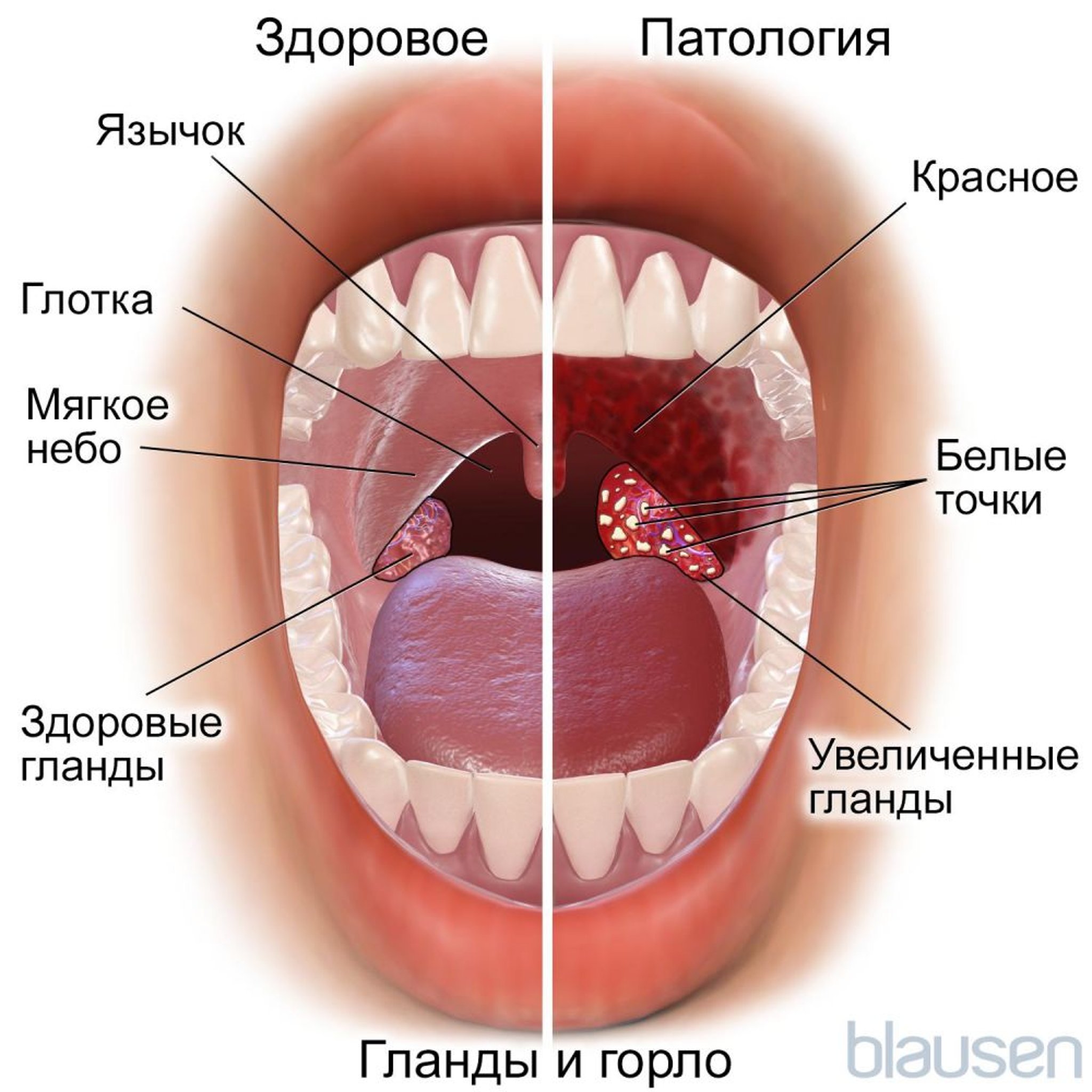 Нормальные и измененные гланды и горло